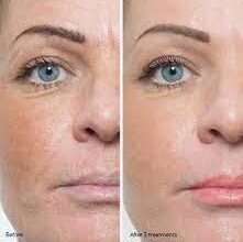 microdermabrasion before and after