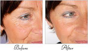 red light therapy for wrinkles before and after