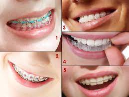 orthodonti