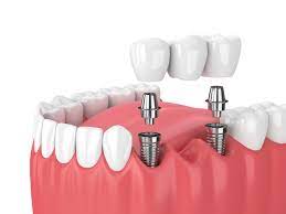 How Much Does A Dental Bridge Cost Without Insurance