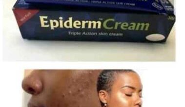 What is epiderm