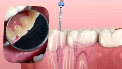 root canal on front teeth