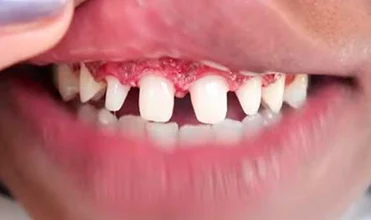 veneer teeth shaving