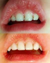front tooth cavity